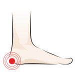 Orthotics for Heel Spurs